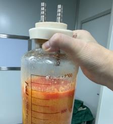 定州水动力吸脂手术要做多久？